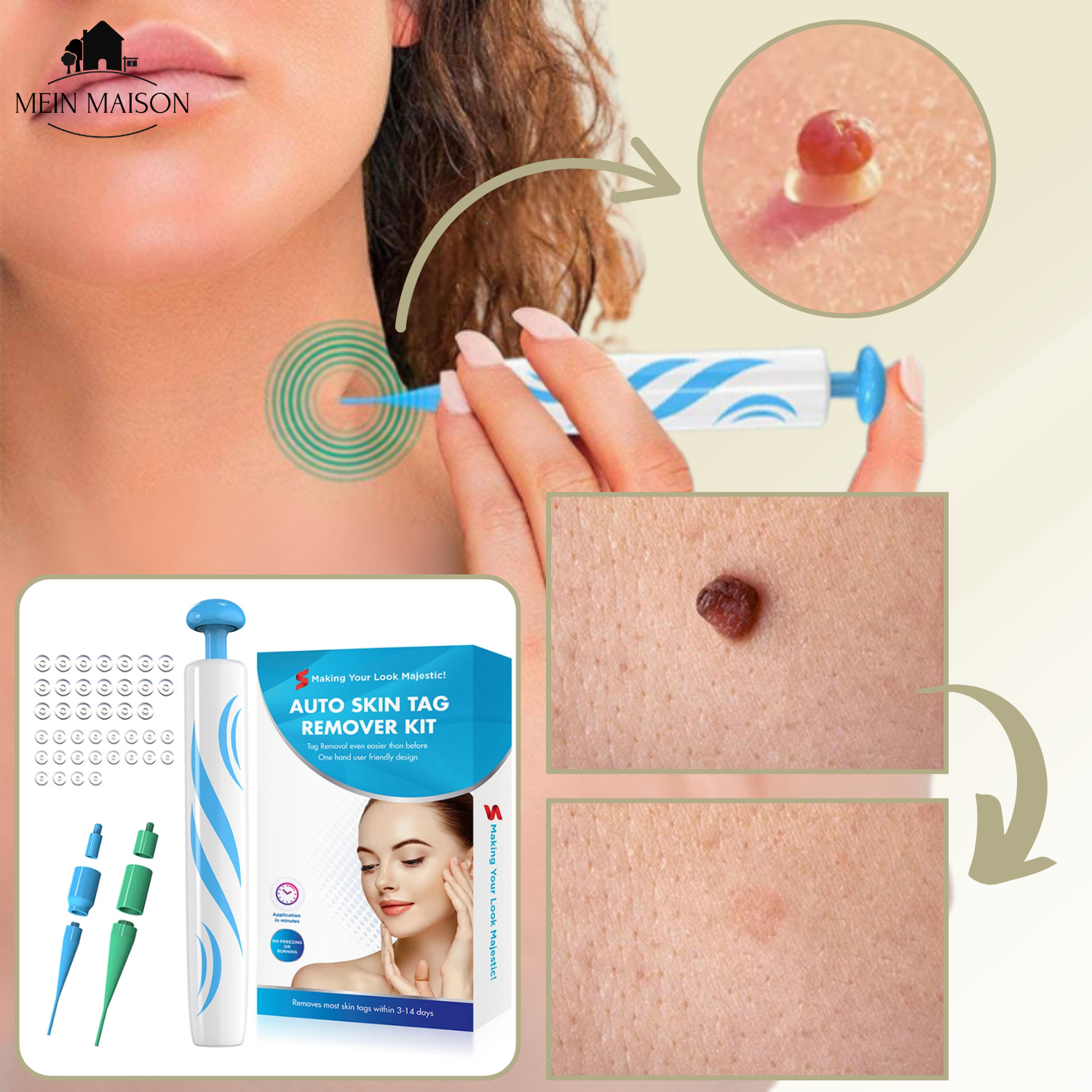 Painless Wart and Mole Remover | Effective Home Skin Tag Removal Treatment