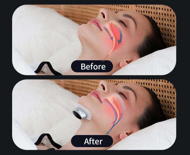 Smart Sleep Apnea Device | Anti-Snoring Aid & CPAP Alternative