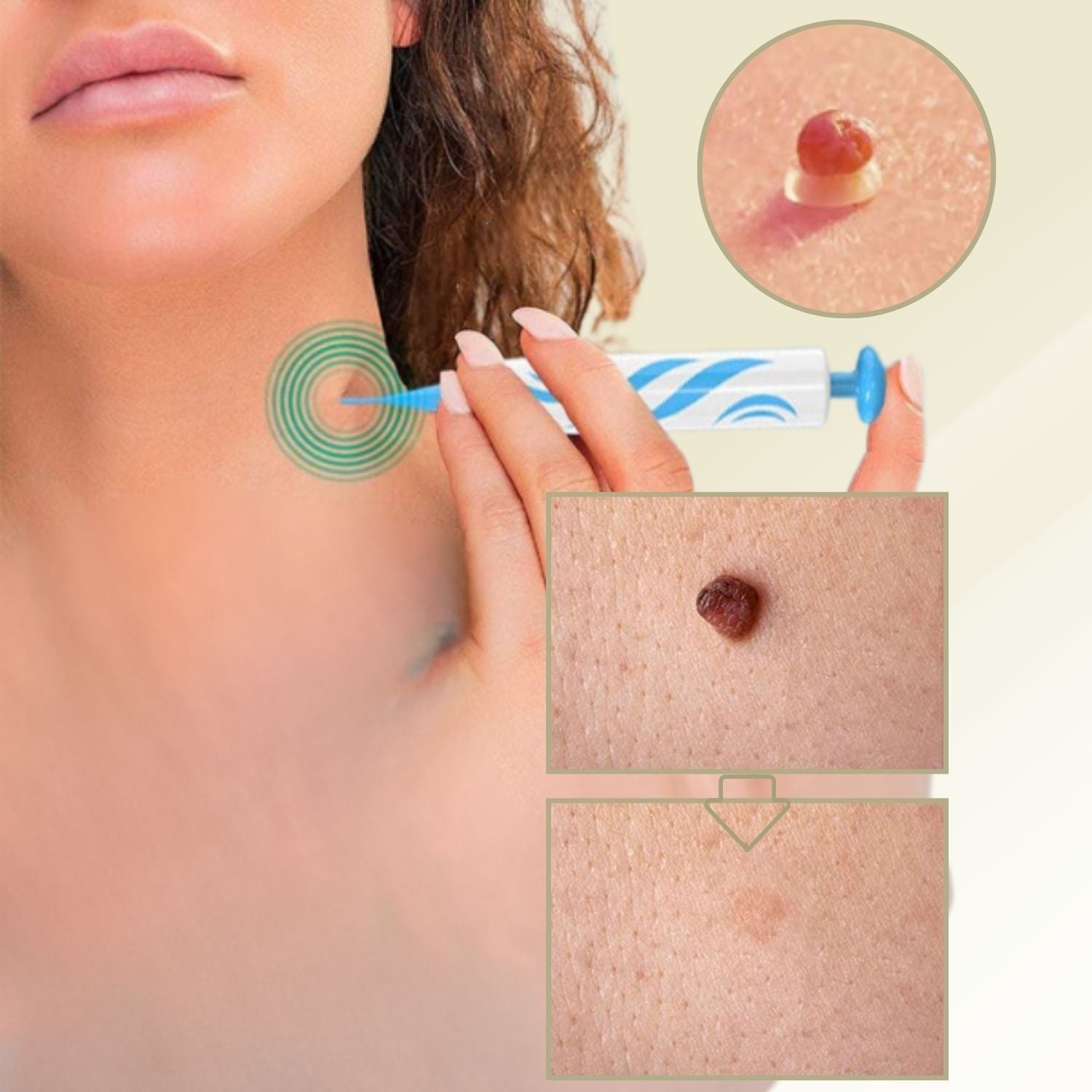 Painless Wart and Mole Remover | Effective Home Skin Tag Removal Treatment