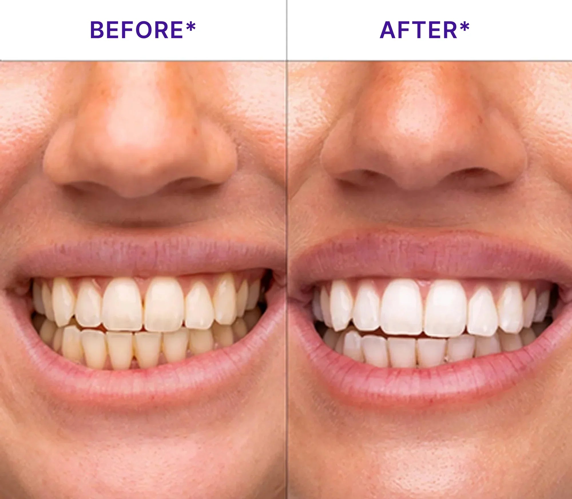 Purple Teeth Whitening Strips | Color-Correcting PAP+ Stain Removal