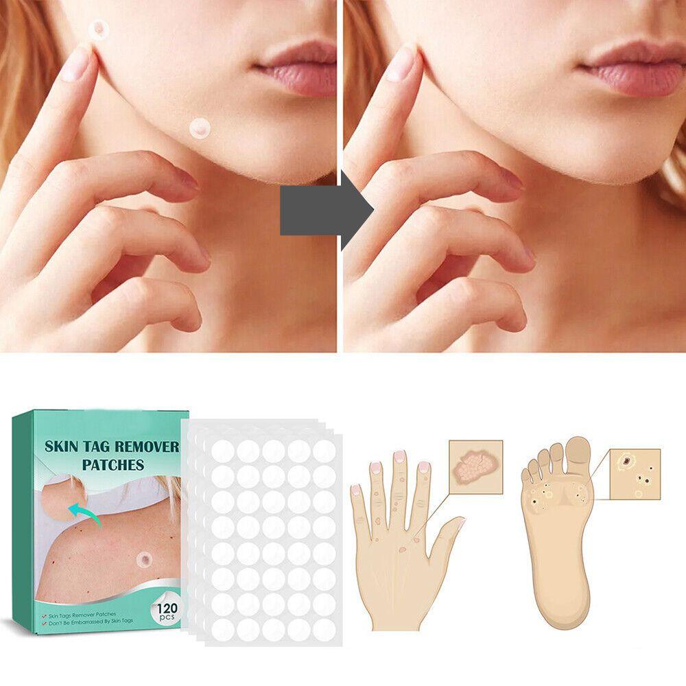 Spot and Wart Removal Patches for Skin Care Kalsten Treatment