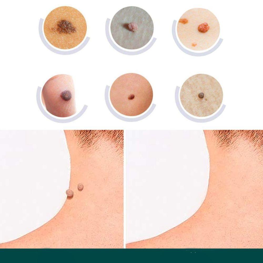 Discreet Skin Clearing Patch for the Removal of Spots and Warts
